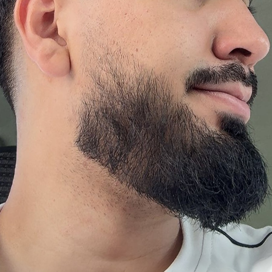 Après utilisation Boost Barber - barbe densifiée