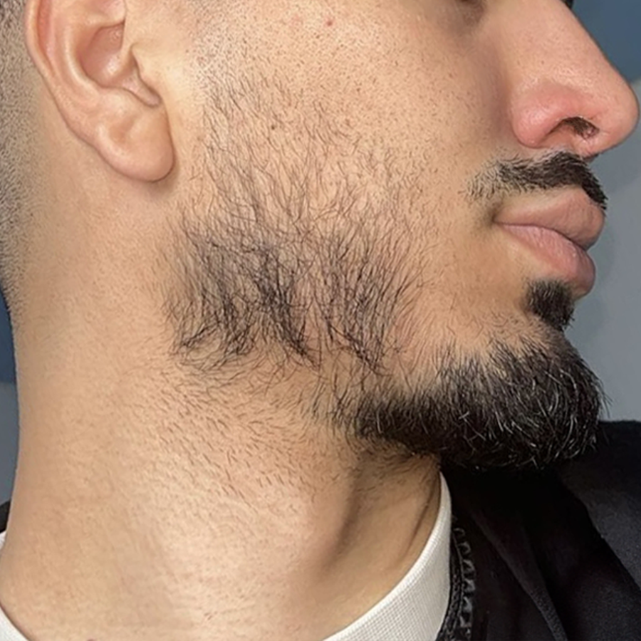 Avant utilisation Boost Barber - zones clairsemées